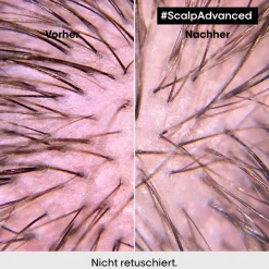 Sale L'Oréal Professionnel Paris L'Oréal Scalp Advanced Anti-Discomfort Intense Soother Treatment