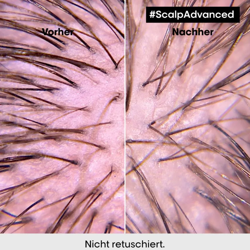 Sale L'Oréal Professionnel Paris L'Oréal Scalp Advanced Anti-Discomfort Intense Soother Treatment